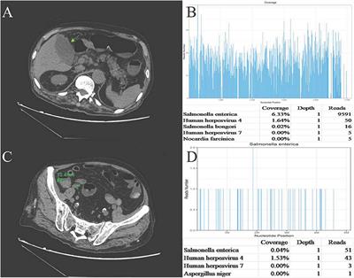 Synchronous Acute Acalculous Cholecystitis and <mark class="highlighted">Appendicitis</mark> Due to Salmonella Group D: A Rare Case Report From China and Review of the Literature